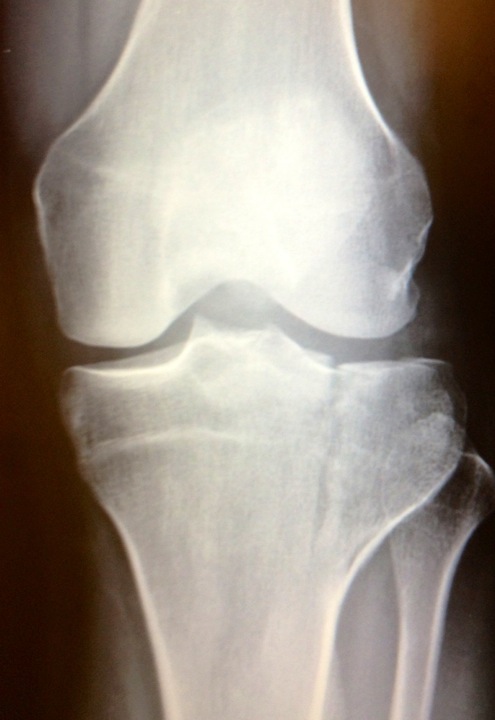knee.JPG Knee
